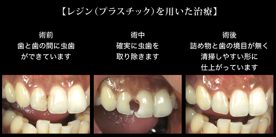 レジン（プラスチック）を用いた治療