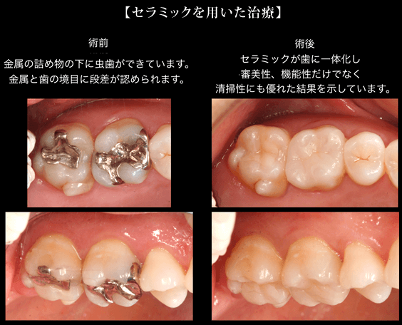 セラミックを用いた治療