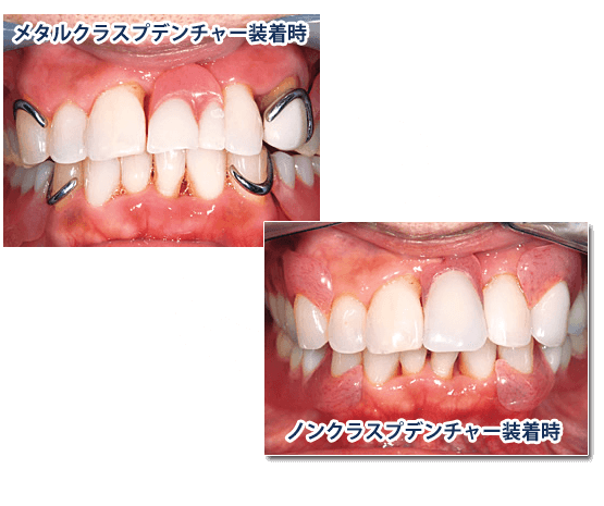 入れ歯・義歯について