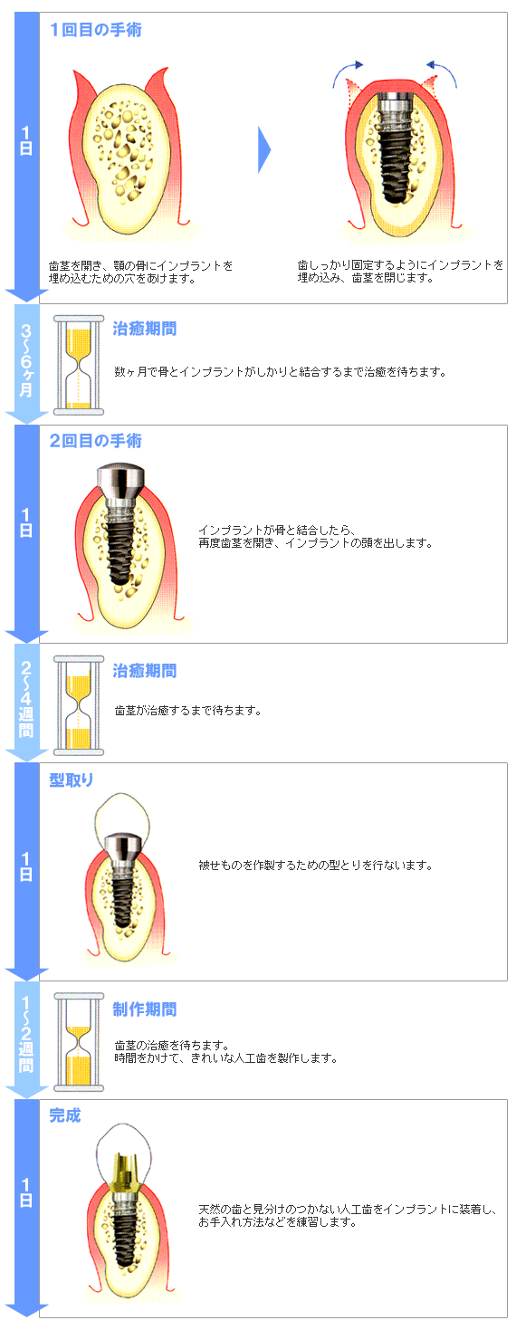 インプラント治療の流れ図解