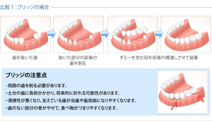インプラントと他の治療法との比較1