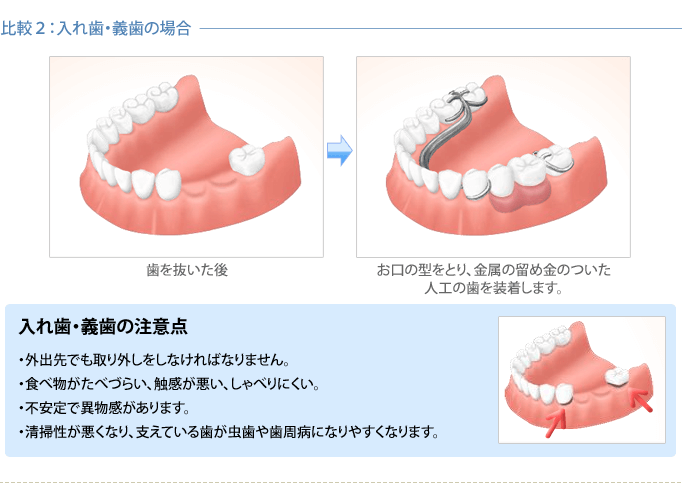 インプラントと他の治療法との比較2