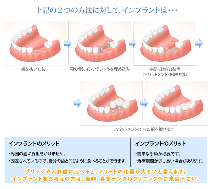 インプラントと他の治療法との比較3