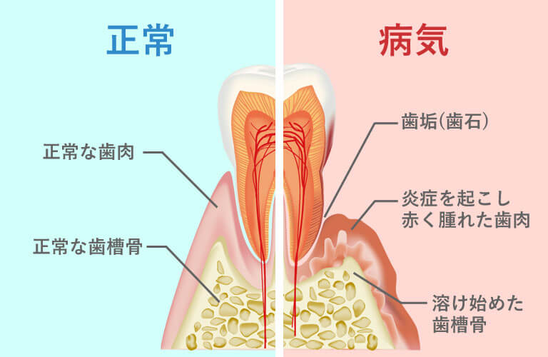 歯周病治療