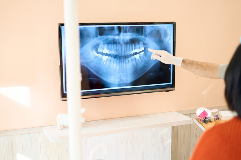 精密根管治療とは？