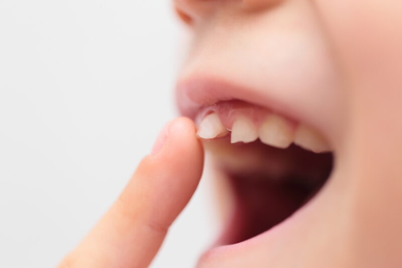 子どもに多い歯肉炎・歯周炎の種類