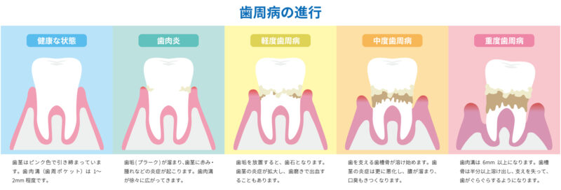 歯周病の怖さ・放置することの影響