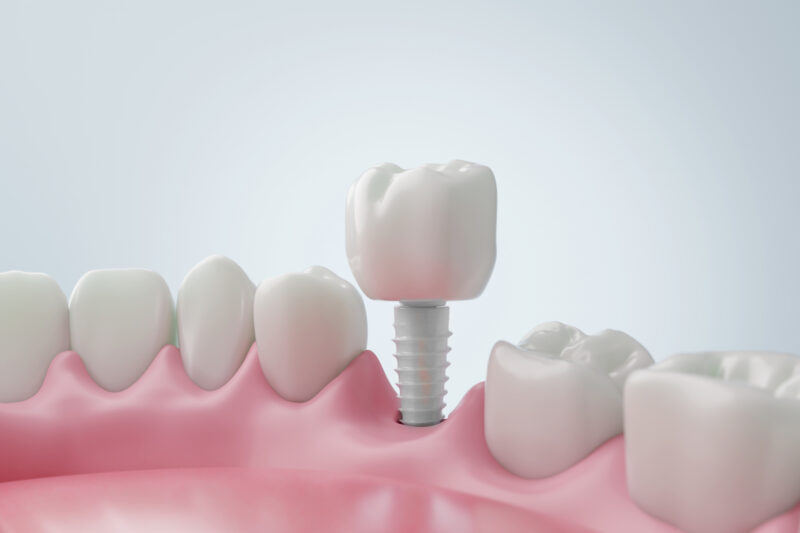 インプラントが怖いと思われる理由