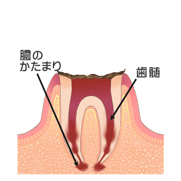 Ｃ４：歯の根まで達した虫歯