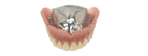総入れ歯（総義歯）