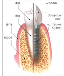 インプラント