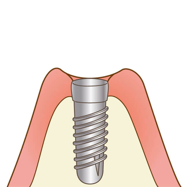 インプラント体を埋入