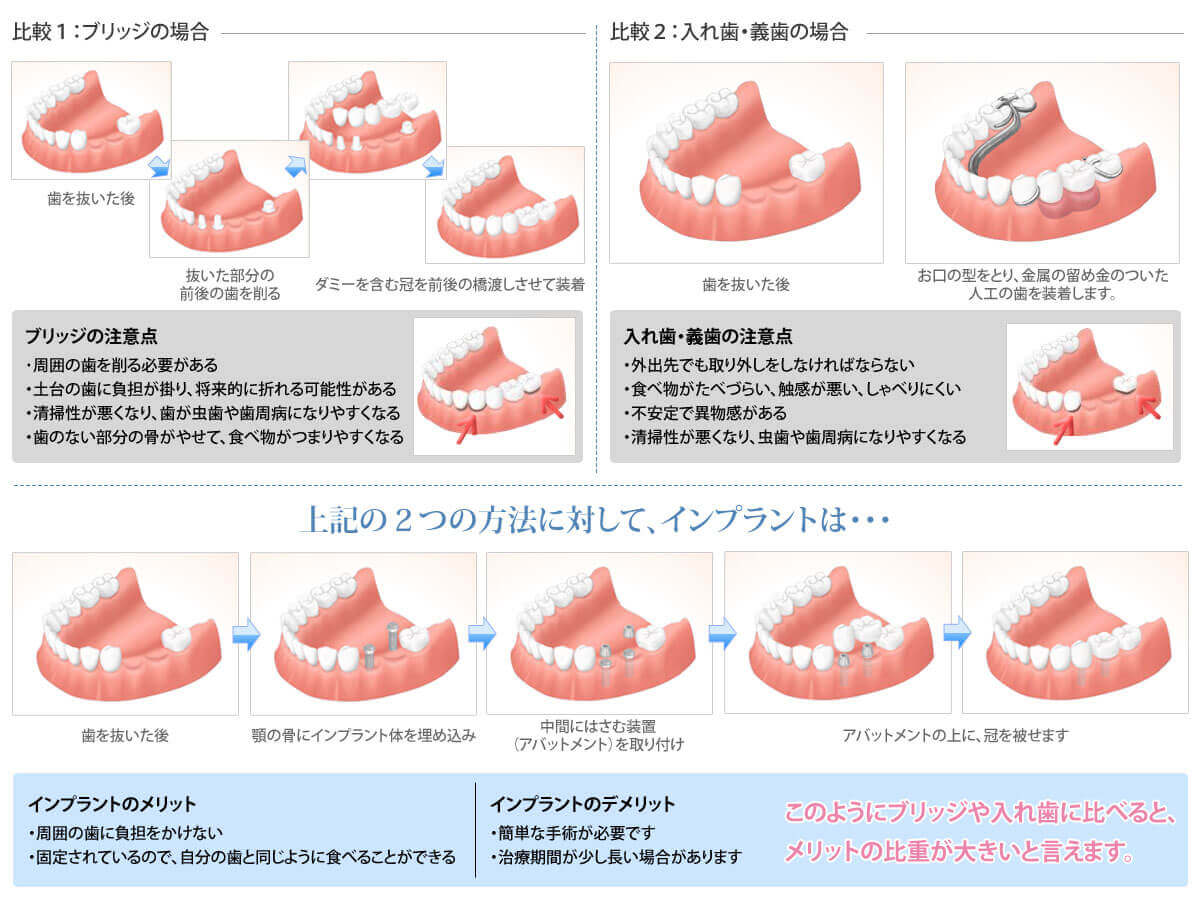 インプラントと他の治療法との比較1