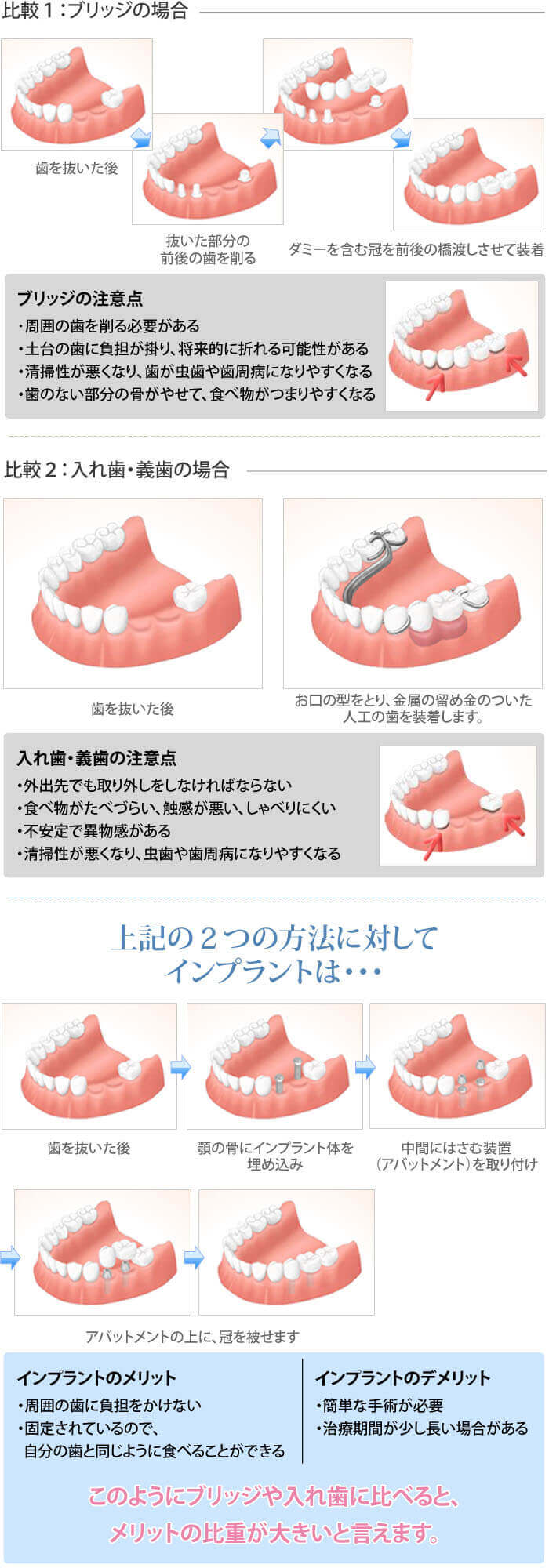 インプラントと他の治療法との比較2