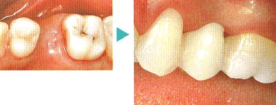 １本欠損のセラミックブリッジによる治療例