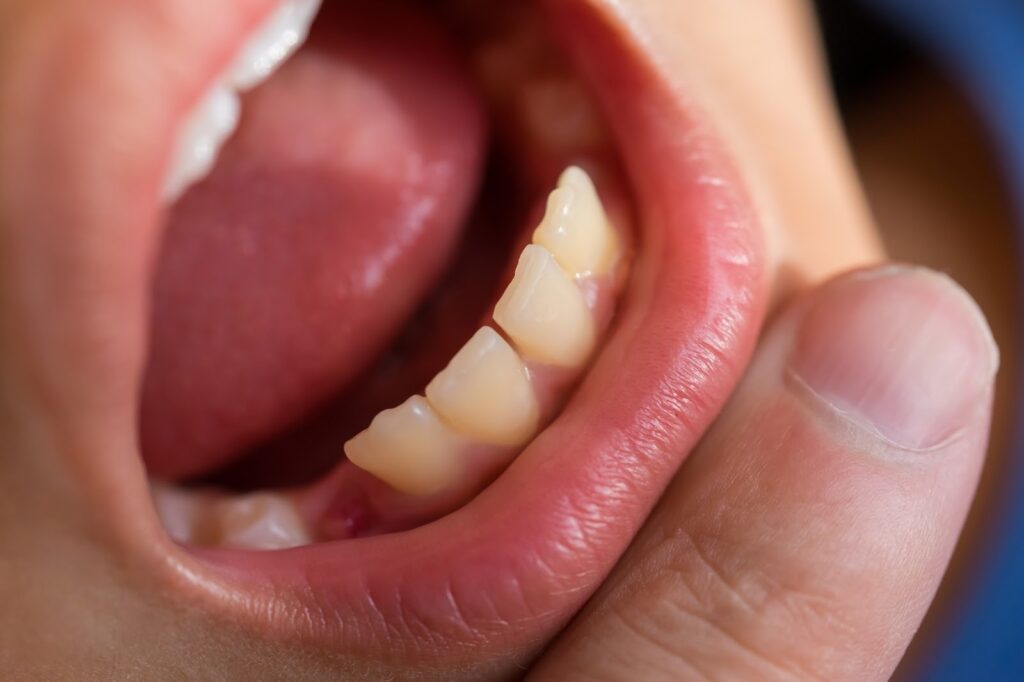 子供の顎が小さいと歯並びに影響はでる？